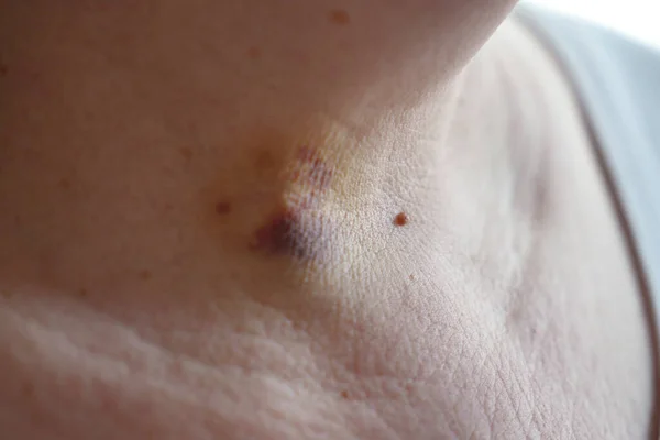 bruises on the neck of a woman as a consequence of laser removal of a benign tumor of the thyroid gland, closeup
