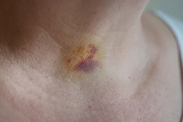 bruises on the neck of a woman as a consequence of laser removal of a benign tumor of the thyroid gland, closeup