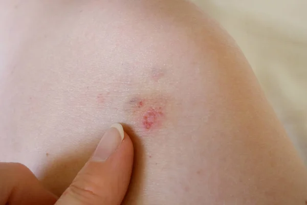 Allergic Rash Dermatitis Leg Skin Red Allergy Spots Skin Inflammation — Stock Photo, Image