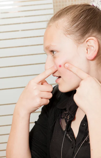 Girl with acne — Stock Photo, Image