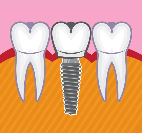 Implanty dentystyczne — Wektor stockowy