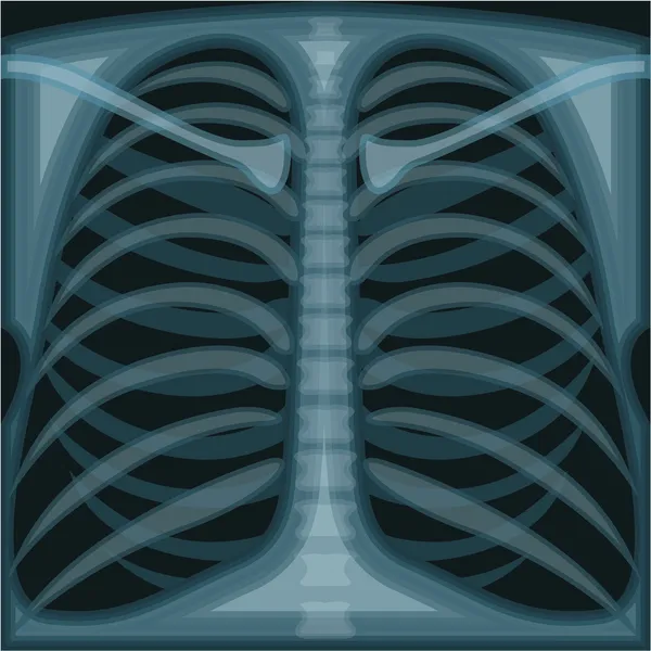 Rayos X pulmonares — Vector de stock