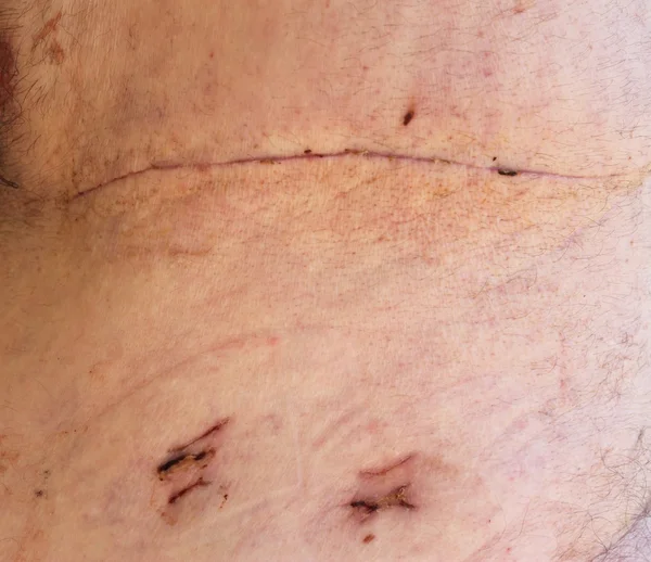 Les cicatrices d'une incision de chirurgie pulmonaire Photos De Stock Libres De Droits