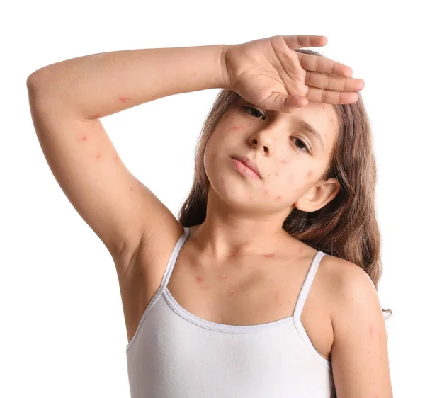 Menina Doente Com Varicela Isolada Branco — Fotografia de Stock