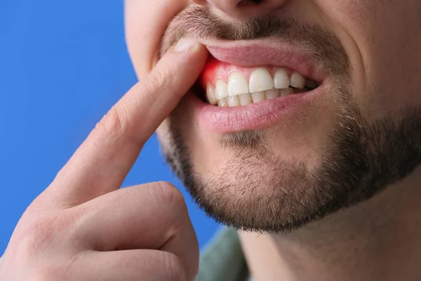 Man Gum Inflammation Blue Background Closeup — Stock Photo, Image