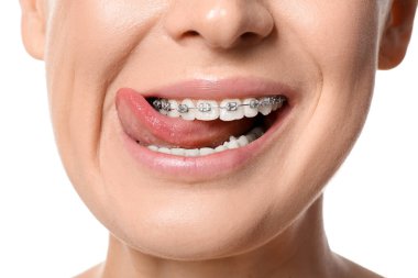 Dişlerinde diş teli olan kadın beyaz arka planda dilini gösteriyor, yakın plan.