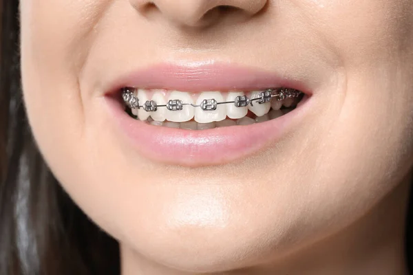 Usmívající Žena Zubními Rovnátky Detailní Záběr — Stock fotografie