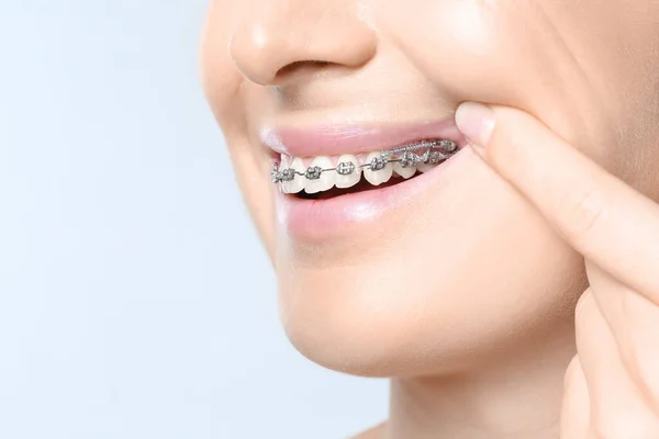 Kobieta Aparatem Dentystycznym Jasnym Tle Zbliżenie — Zdjęcie stockowe