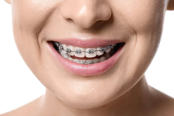 Donna Con Apparecchio Dentale Sfondo Bianco Primo Piano — Foto Stock