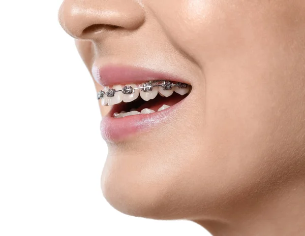 Frau Mit Zahnspange Auf Weißem Hintergrund Nahaufnahme — Stockfoto