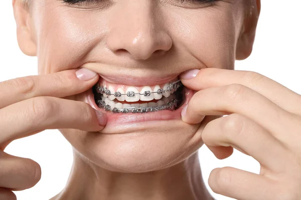 Wanita Dengan Kawat Gigi Pada Latar Belakang Putih Menutup — Stok Foto