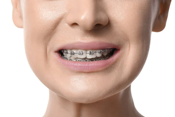 白い背景に歯のブレースを持つ女性 クローズアップ — ストック写真