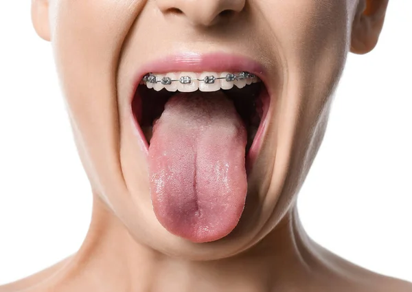 Mujer Con Tirantes Dentales Mostrando Lengua Sobre Fondo Blanco Primer —  Fotos de Stock
