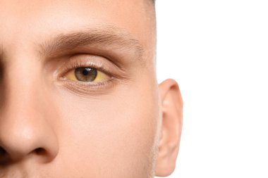 Beyaz arka planda sarı gözlü genç adam, yakın plan. Hepatit belirtileri