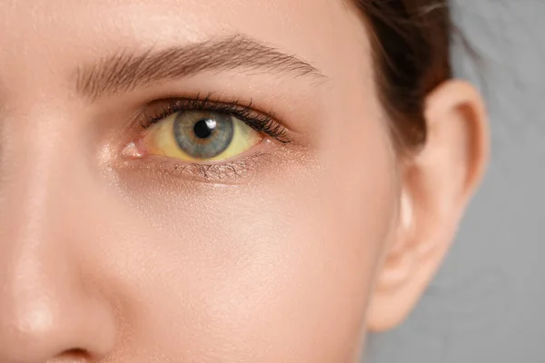 Young Woman Yellow Eyes Closeup Hepatitis Symptom — Stock Photo, Image