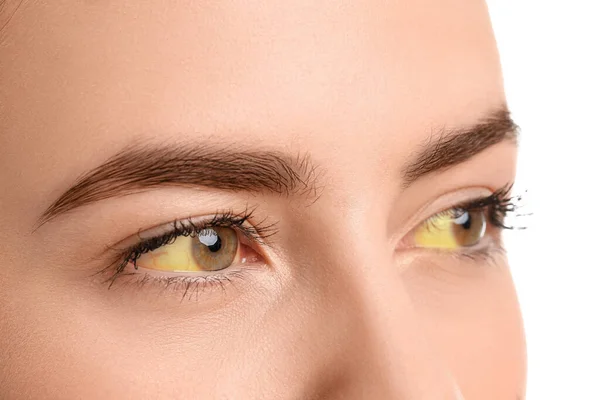 Young Woman Yellow Eyes White Background Closeup Hepatitis Symptom — стоковое фото