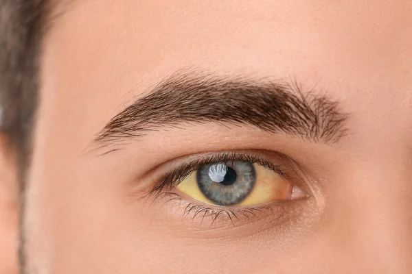 Young Man Yellow Eyes Closeup Hepatitis Symptom — Stock Fotó