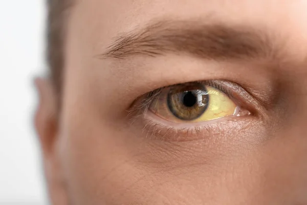 Man with yellow eyes, closeup. Hepatitis symptom