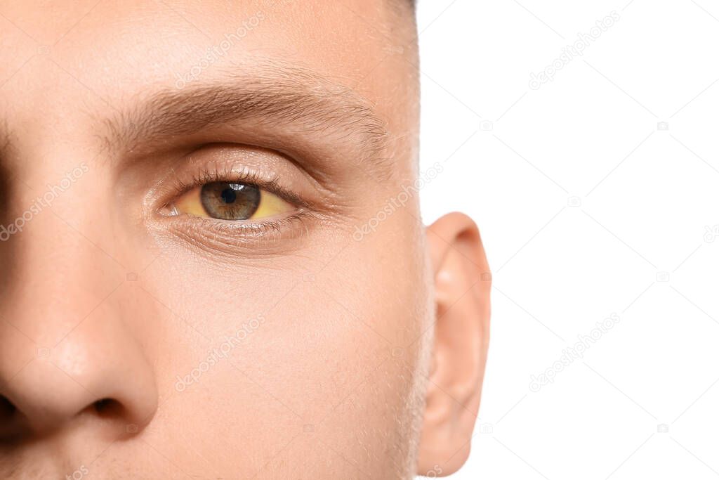 Young man with yellow eyes on white background, closeup. Hepatitis symptom