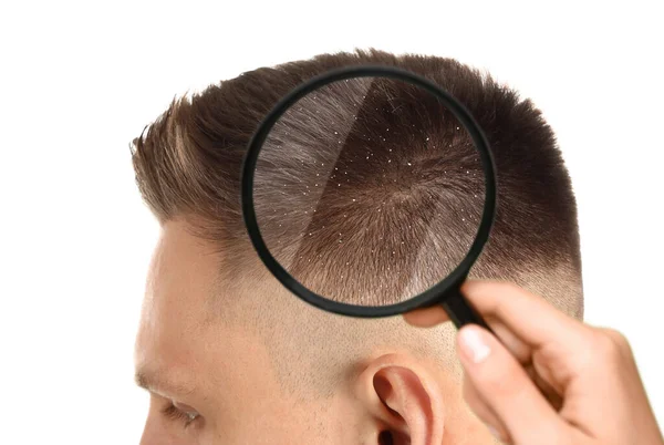 Looking Young Man Hair Magnifier Problem Dandruff — Stock Photo, Image