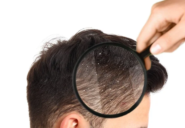 白い背景に拡大鏡を通して若い男の髪を見て ダンルフの問題 — ストック写真