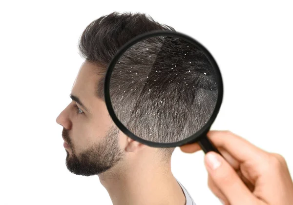 Beyaz Arka Plandaki Büyüteçle Genç Adamın Saçlarına Bakıyorum Kepek Problemi — Stok fotoğraf
