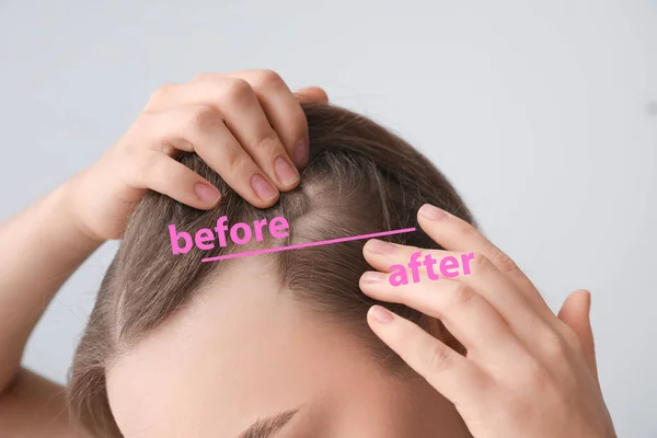 Hafif Arka Planda Saç Dökülmesi Öncesi Sonrası Kadın Yakın Plan — Stok fotoğraf