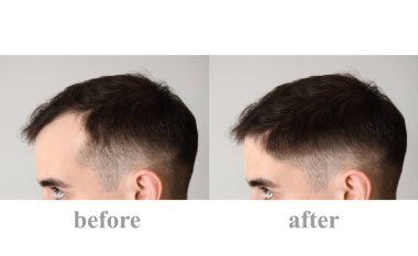 Young man before and after hair loss treatment on light background