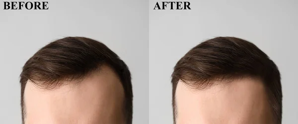 Hombre Joven Antes Después Del Tratamiento Pérdida Cabello Sobre Fondo — Foto de Stock