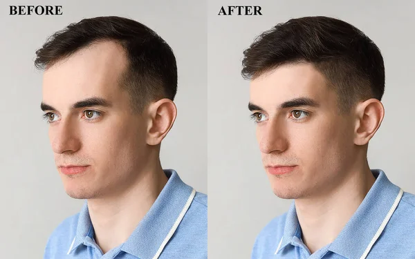 Young Man Hair Loss Treatment Light Background — Stock Photo, Image