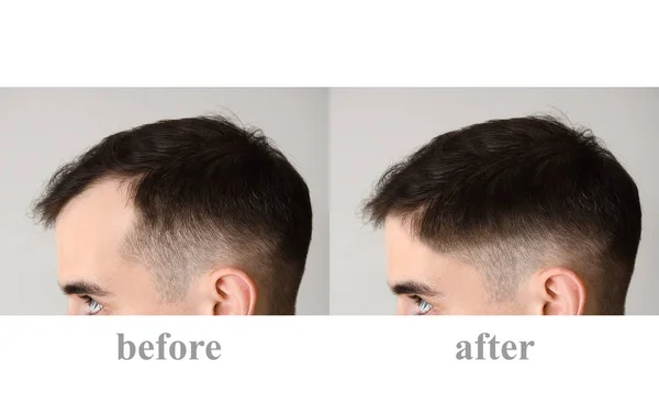 Молода Людина Після Лікування Випадіння Волосся Світлому Фоні — стокове фото