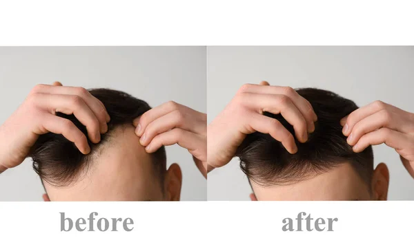 Young Man Hair Loss Treatment Light Background Closeup — Stock fotografie