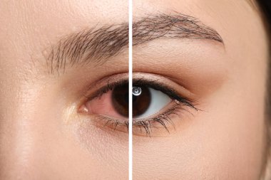 Closeup view of young woman before and after eye treatment