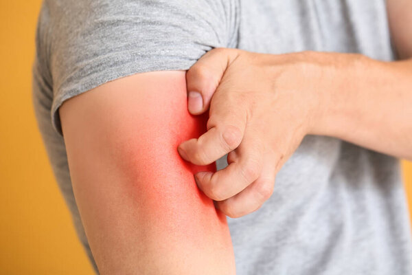 Young man scratching his skin, closeup. Allergy concept