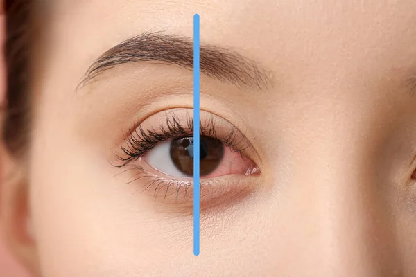 Closeup View Young Woman Eye Treatment — Stockfoto