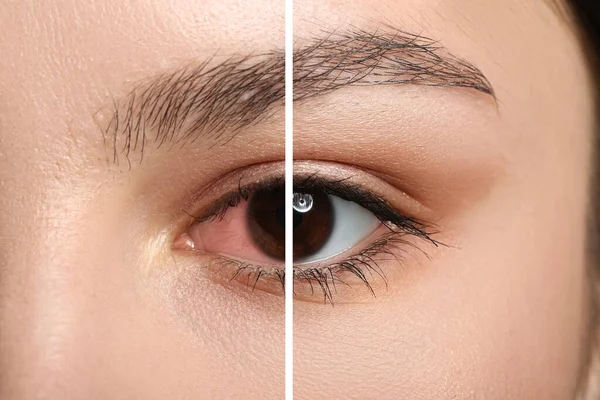 Closeup View Young Woman Eye Treatment — Foto de Stock