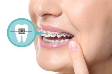 Beyaz arka planda diş telleri olan genç bir kadın, yakın plan.