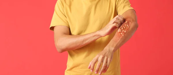 赤い背景に彼の腕を引っ掻いている猿人の病気 — ストック写真