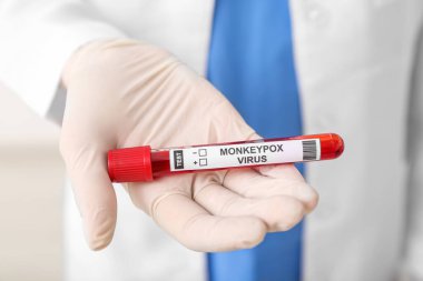 Arka planda kan örneği olan kadın doktor, yakın plan. Maymun Çiçeği virüsü konsepti