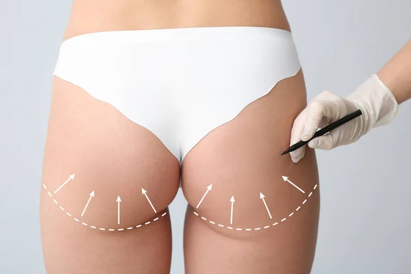Plastic Surgeon Applying Marks Female Body Light Background Closeup — Stock Photo, Image