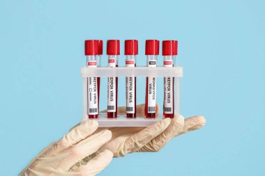Hands of doctor with samples of monkeypox virus on blue background