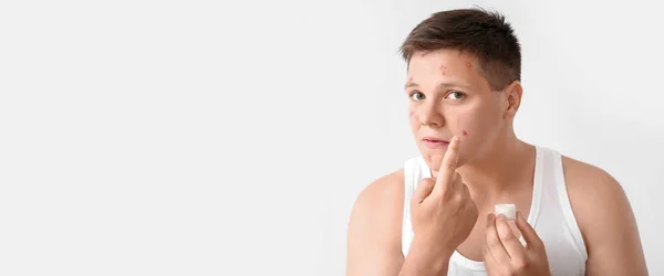 Teenage Boy Applying Remedy Acne Light Background Space Text — Stock Photo, Image