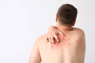 Teenager ill with monkeypox on light background