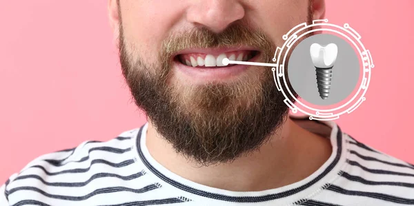 Man Implanted Teeth Pink Background Closeup — Stock Photo, Image