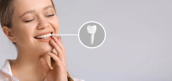 Smiling Young Woman Implanted Teeth Light Background — Stock Photo, Image
