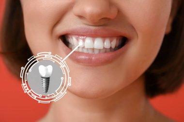 Woman with implanted teeth, closeup