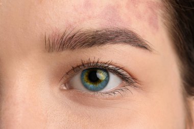 Young woman with heterochromia iridis, closeup