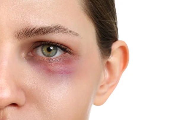 Young woman with bruise under eye on white background, closeup