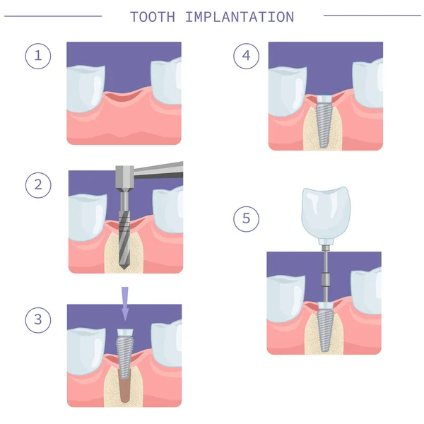 Implante Dental Inmediato Implante Dental Moderno Instrucciones Paso Paso Ilustración — Archivo Imágenes Vectoriales