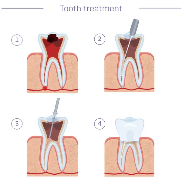 Tooth Treatment Step Step Instructions Endodanic Treatment Modern Dentistry Illustration — Stock Vector